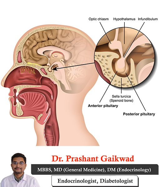 dr-prashant-gaikwad-pituitary-disorders-consultant